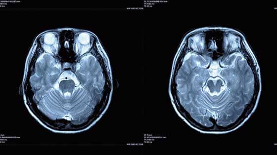 1977 MRI Used on First Live Person 1977 MRI Used on First Live Person