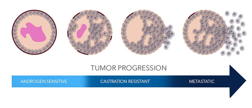 Prostate Cancer Tumor Progression